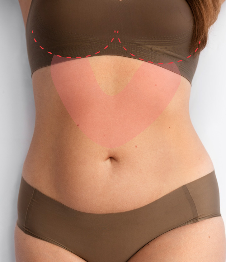 Abdominoplastia Reversa