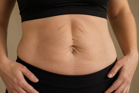 Separação dos músculos abdominais - diástase - Abdominoplastia com Lipoaspiração